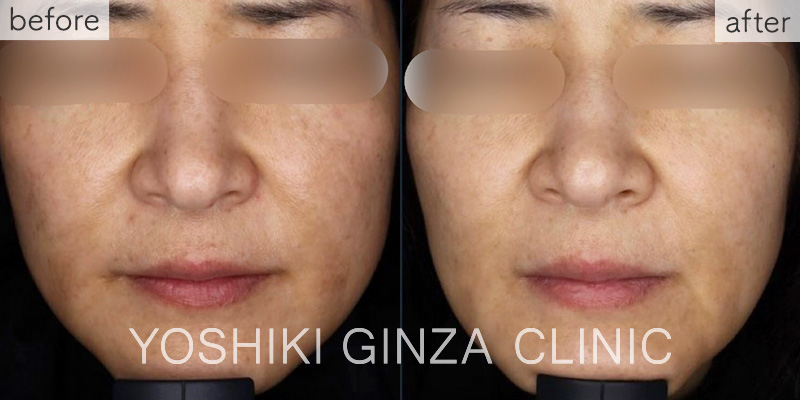 フォトフェイシャルステラ ほほ＋鼻あご×3回の症例写真