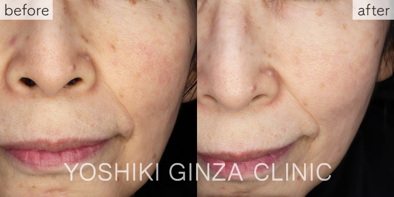 フォトフェイシャルステラ ほほ＋鼻あご×3回の症例写真