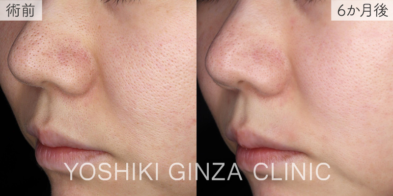 フォトフェイシャルステラ 全顔（ニキビや毛穴縮小効果）×4回の症例写真