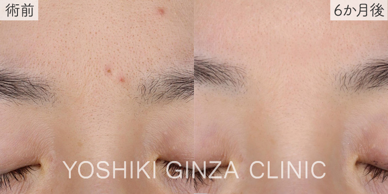 フォトフェイシャルステラ 全顔（ニキビや毛穴縮小効果）×4回の症例写真