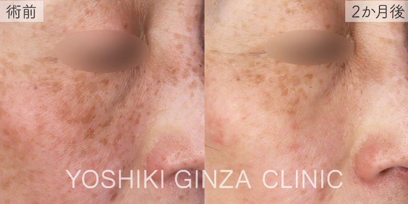 フォトフェイシャルステラ ほほ＋鼻あご×2回の症例写真