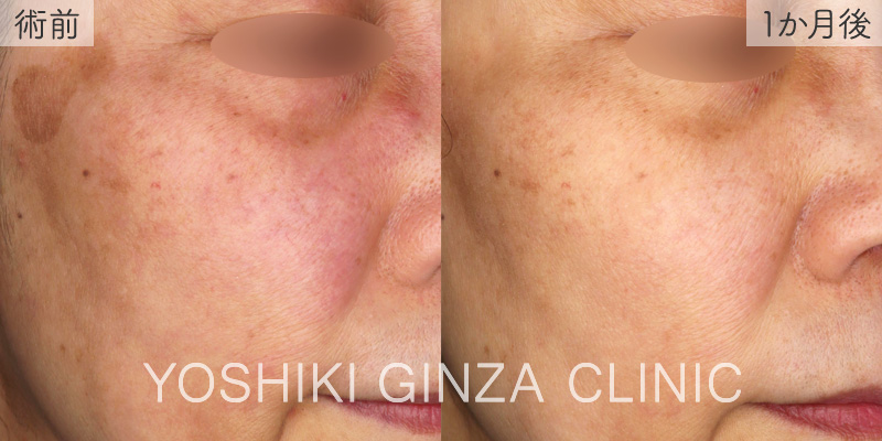 フォトフェイシャル ほほ×3回の症例写真