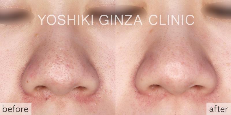 フォトフェイシャル ほほ＋鼻あご×5回の症例写真