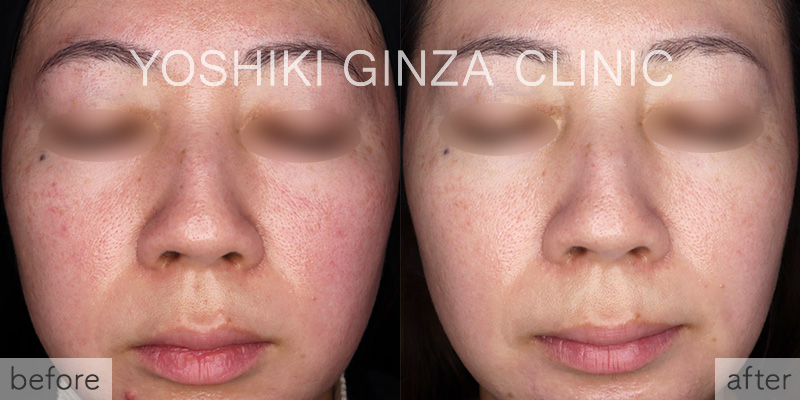 フォトフェイシャル ほほ×6回の症例写真