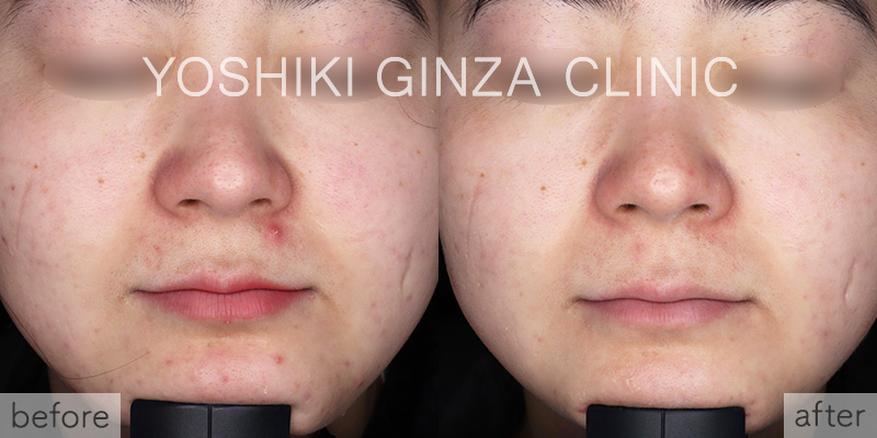 フォトフェイシャル 全顔×2回の症例写真