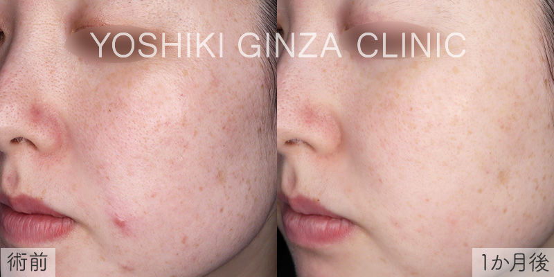 フォトフェイシャル全顔×4回の症例写真