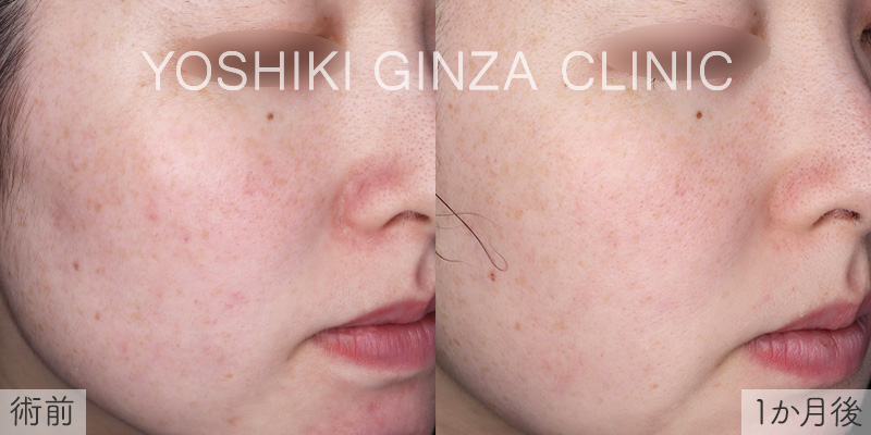 フォトフェイシャル全顔×4回の症例写真