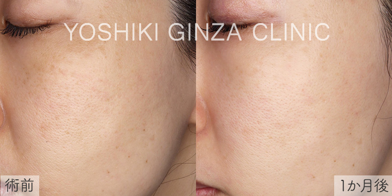 フォトフェイシャルほほ×4回の症例写真