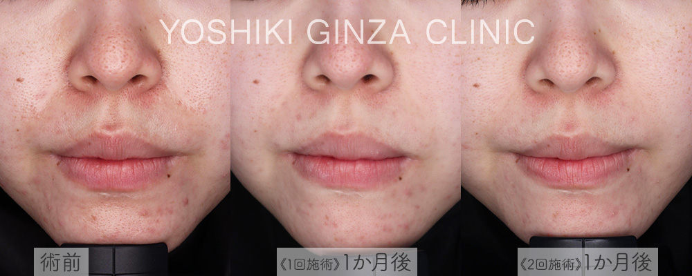 フォトフェイシャル全顔×2回の症例写真