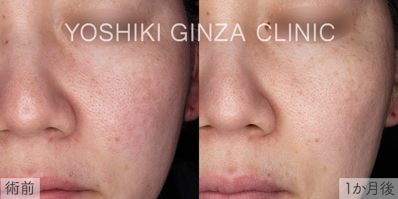 フォトフェイシャルほほ×4回の症例写真