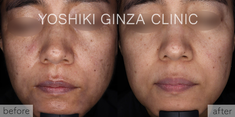 フォトフェイシャルほほ鼻あご×10回の症例写真