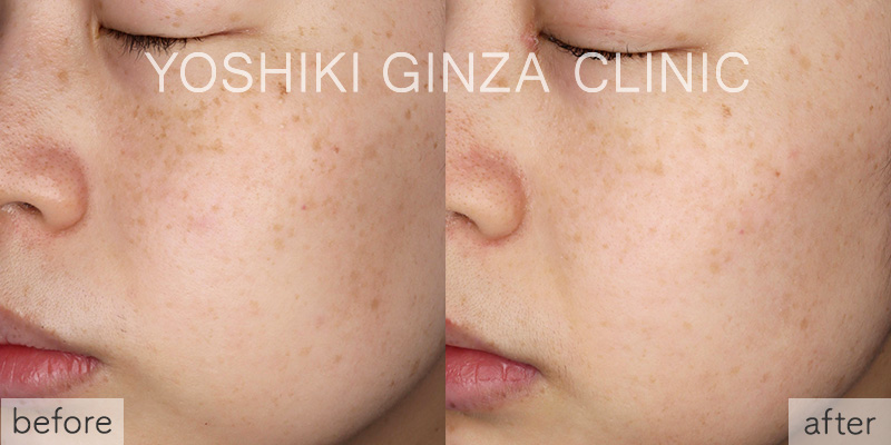 フォトフェイシャルほほ×2回の症例写真