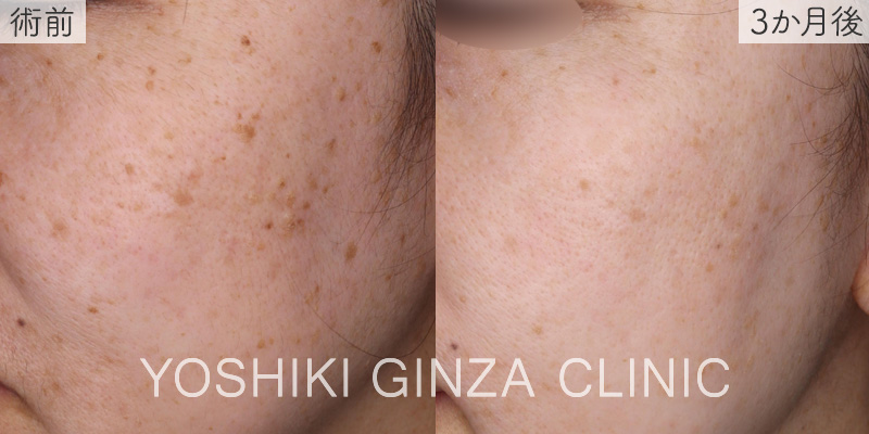 ピコスポット×2回の症例写真