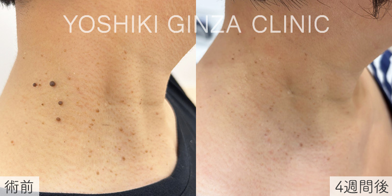 ピコスポット＋一部切除の症例写真