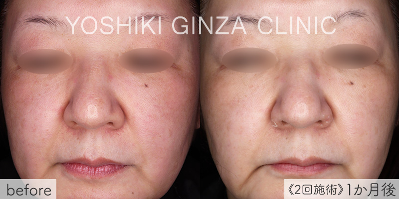 ピコトーニングの症例写真