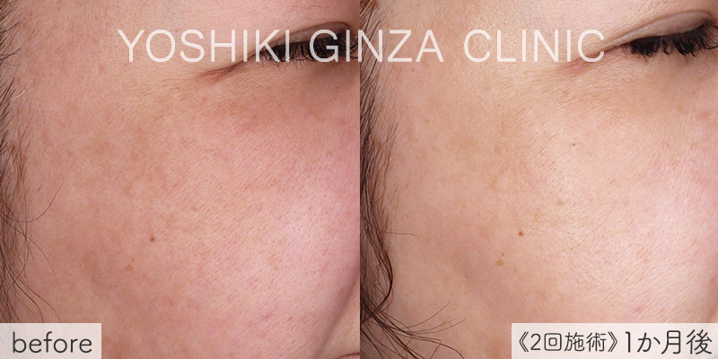 ピコトーニングの症例写真