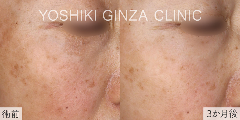 ポテンツァMの症例写真