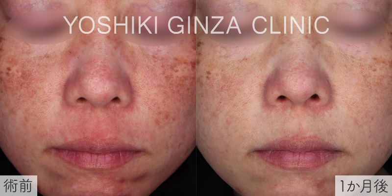 ポテンツァMの症例写真