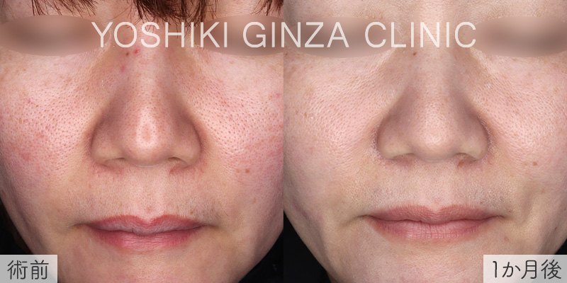 スマートサイドスクエア ほほの毛穴の症例写真