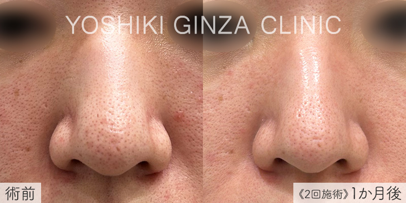 スマートサイドスクエア 鼻の症例写真