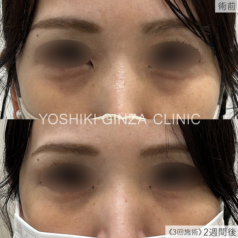 スネコス(SUNEKOS) 目元の症例写真