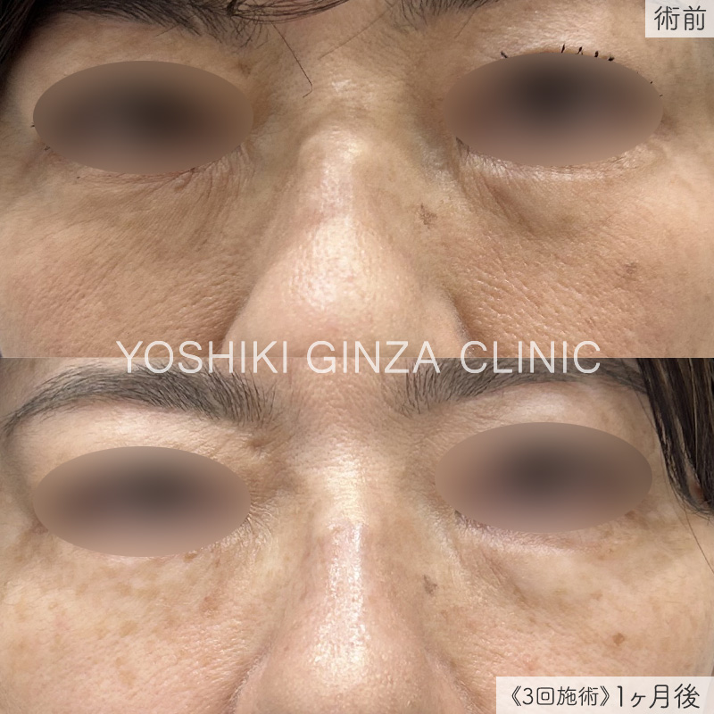 スネコス(SUNEKOS) 目元の症例写真