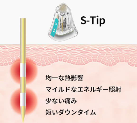 痛みが少なくダウンタイムも短いマイルドなエネルギー照射