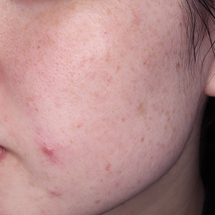 Hyperpigmentation (Dark Spot) Type