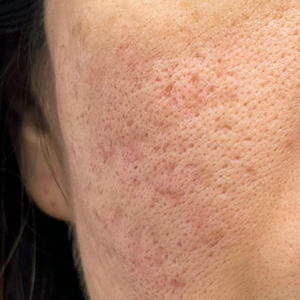 Depressed (Indented) Type