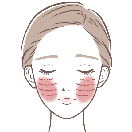 頬全体の細かいしわ