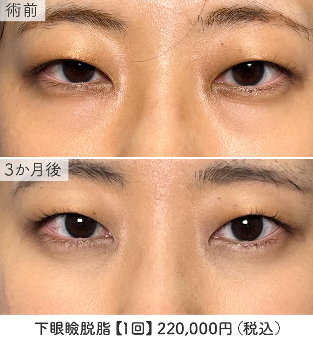 下眼瞼脱脂術の症例写真