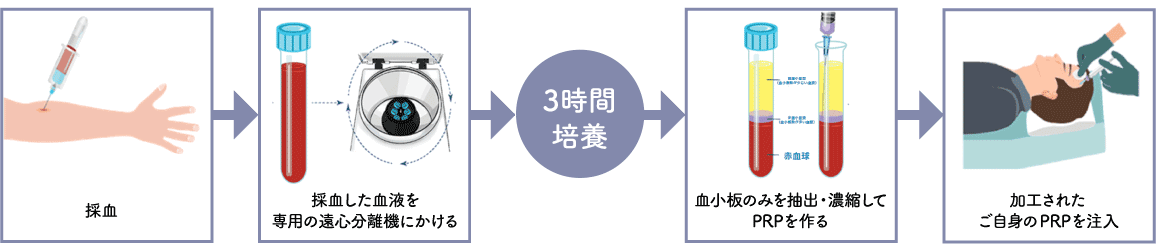 ACRS療法の治療の流れ