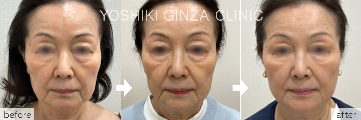 鼻以外全顔の症例写真
