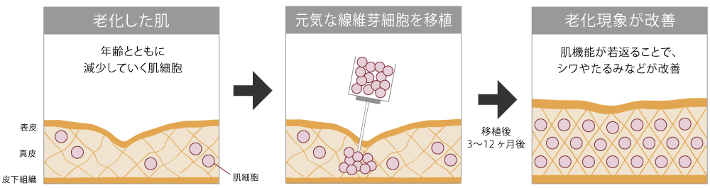 肌細胞の移植イメージ