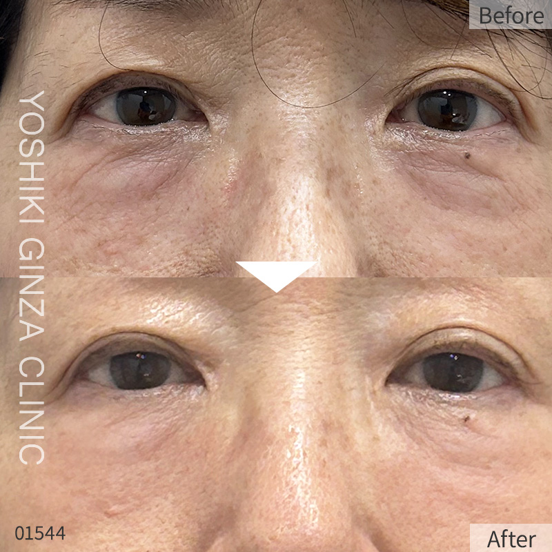 Collagen Injection – case photos