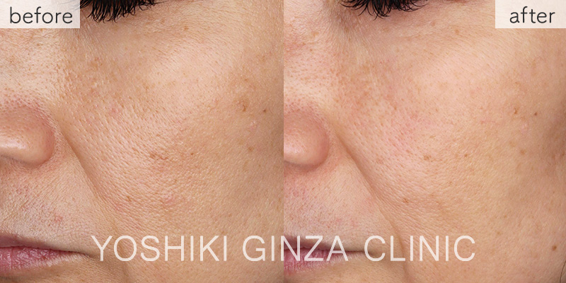 キュラセン(水光注射でプラセンタ注入)症例写真