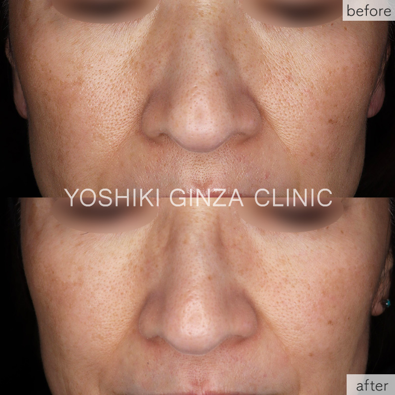 キュラセン(水光注射でプラセンタ注入)症例写真