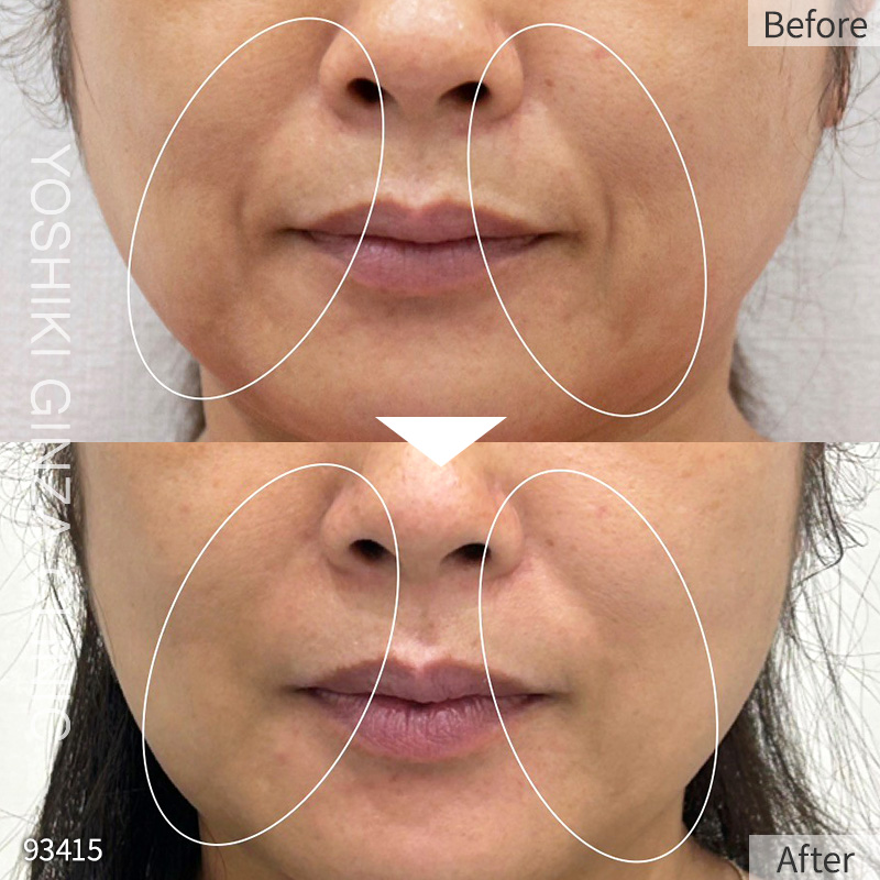 Hyaluronic acid injection – case photos