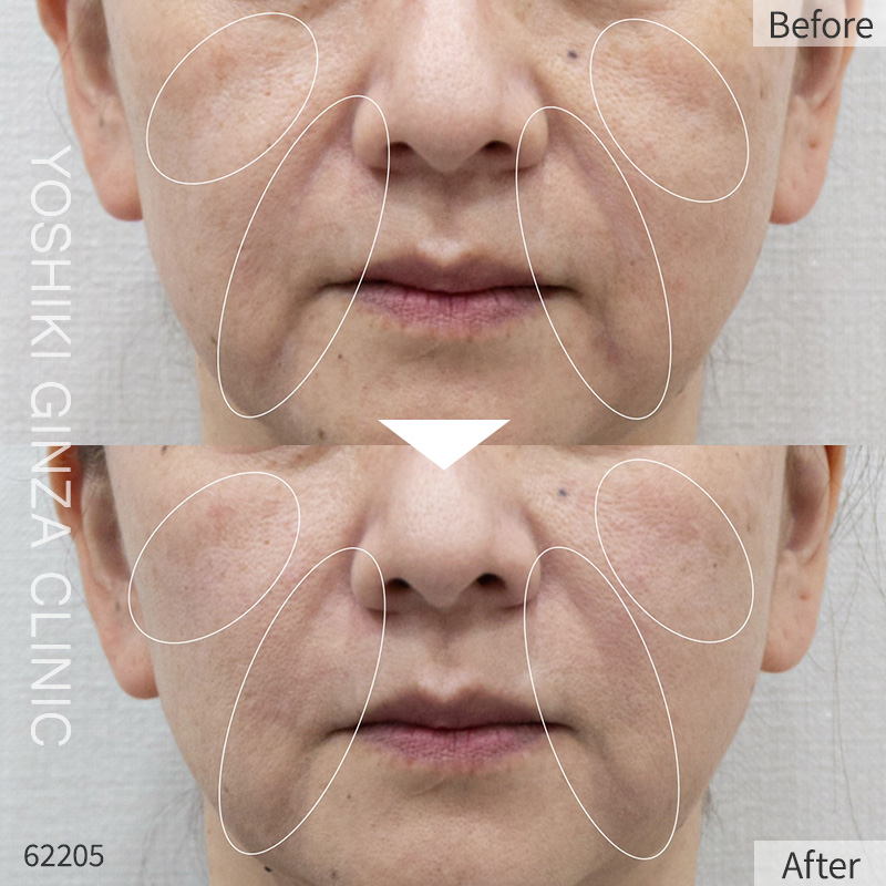 Hyaluronic acid injection – case photos