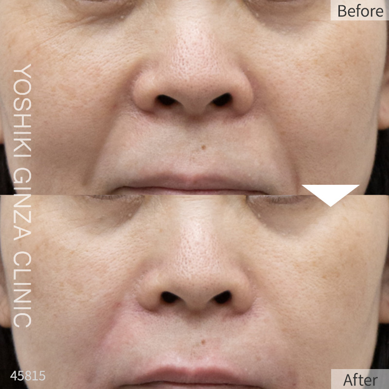 Hyaluronic acid injection – case photos