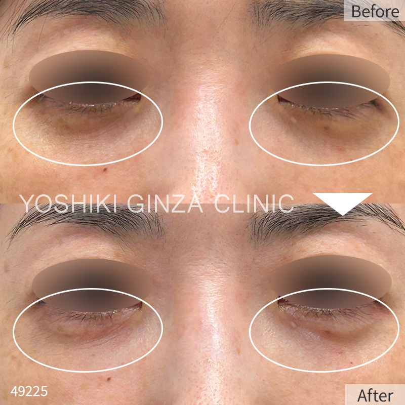 Hyaluronic acid injection – case photos