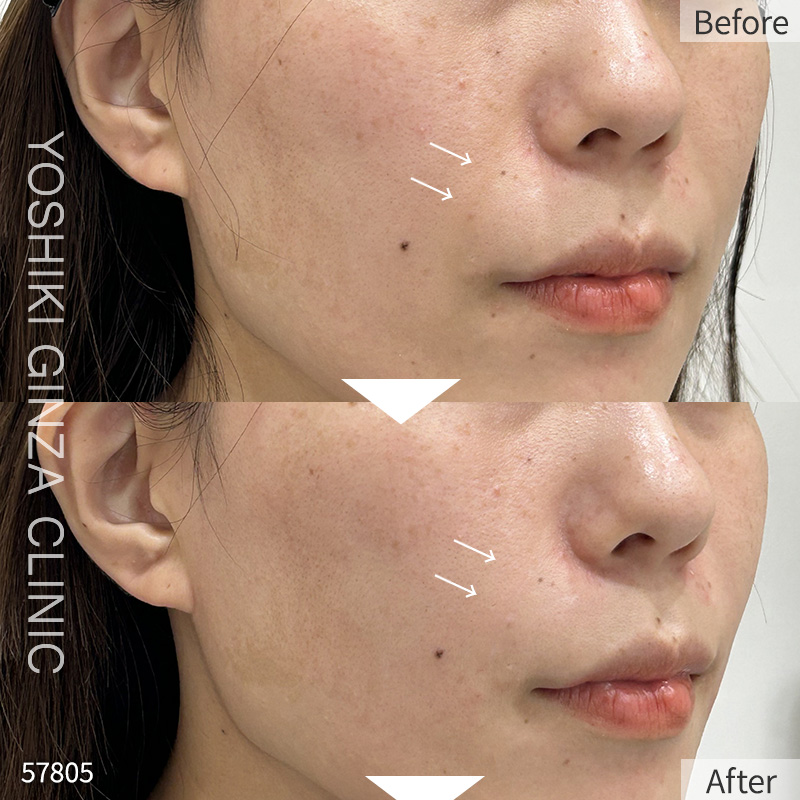 Hyaluronic acid injection – case photos