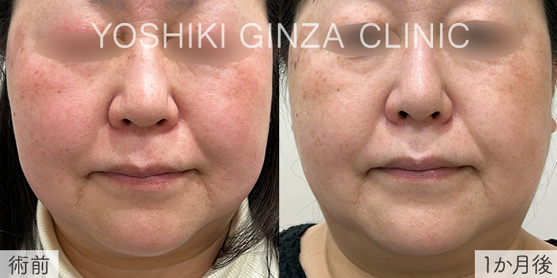 ミラノリピールの症例写真