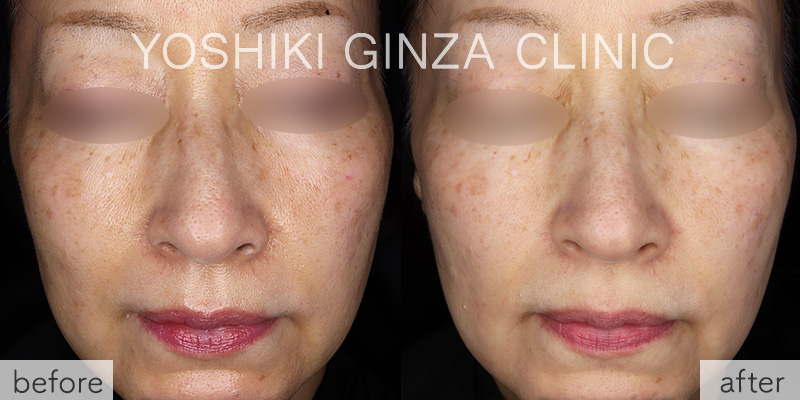 ケミカルピーリング+ビタミンCイオン導入+フォトフェイシャルステラの症例写真