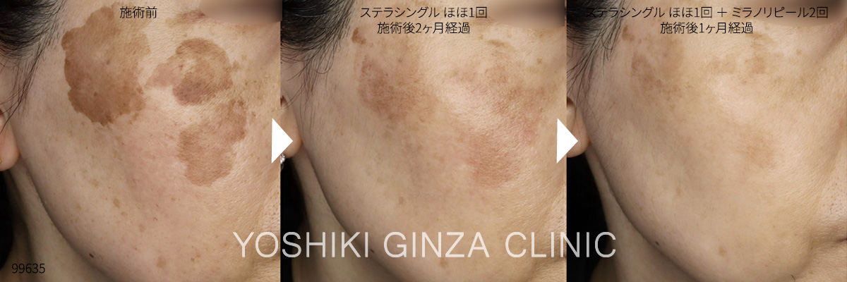 ステラシングル+ミラノリピールの症例写真