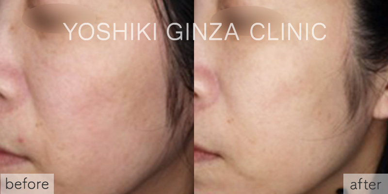 ピコトーニングの症例写真