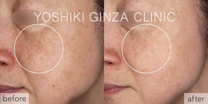 ピコトーニングの症例写真