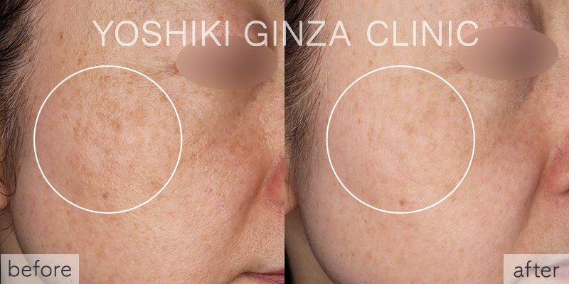 ピコトーニングの症例写真