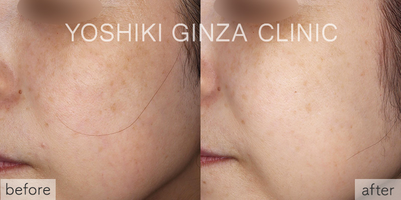 ピコトーニングの症例写真