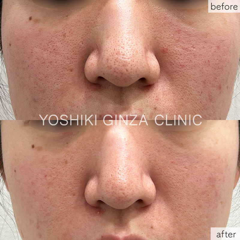Smart Side Square (Cheeks & Nose) 